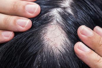 Alopecia areata, ok Aifa a rimborsabilità nuovo trattamento