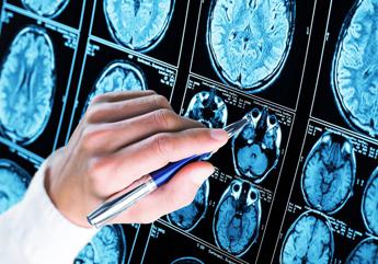 Scoperto meccanismo chiave dell’Alzheimer: speranza per diagnosi e cure