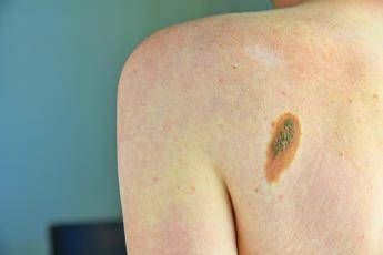 L’oncologo Ascierto: “Aumentano casi melanoma, lampade abbronzanti come fumo”